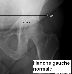 Hanche gauche normale-2