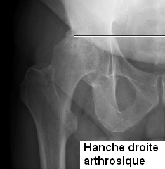 Hanche droite arthrosique