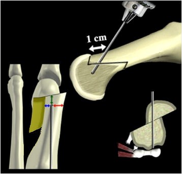 Mini-scarf hallux valgus-1169e