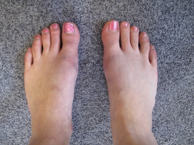 Hallux valgus bilateral apres intervention-845eb