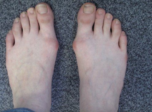Hallux valgus bilateral avant intervention-1e739-10f2d