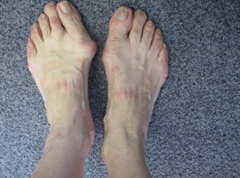Hallux valgus et griffe du 2eme orteil avant intervention-905b4-4183b