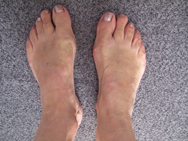 Hallux valgus et griffe du 2eme orteil apres intervention-93568