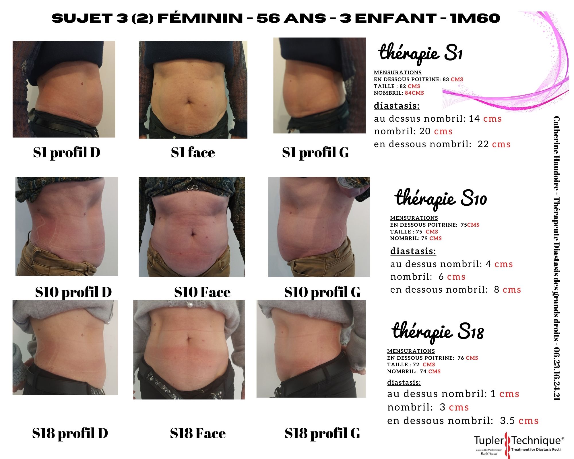  diastasis sujet 3 2 nathalie
