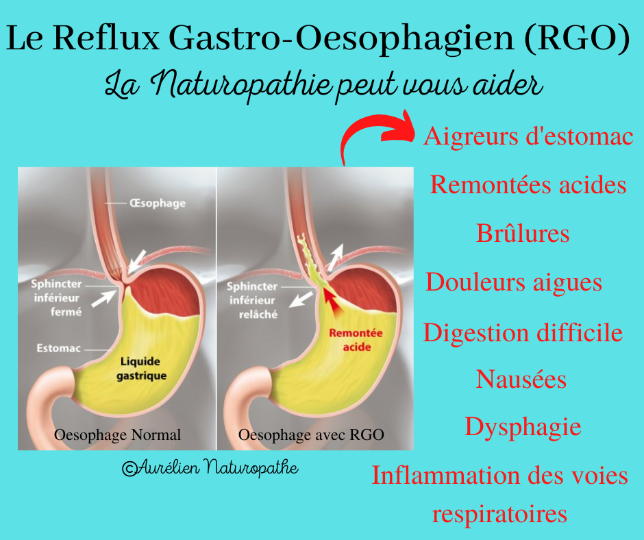 Reflux-gastro-oesophagien