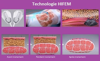 electrostimulation aix marseille par ondes hifem
pas cher plan de cuques allauch marseille 13013