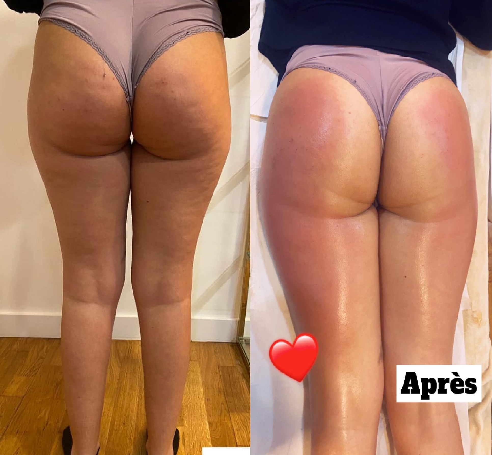 radiofrequence cutanee marseille soin cellulite avant apres avis resultat sur plan de cuques allauch 13013