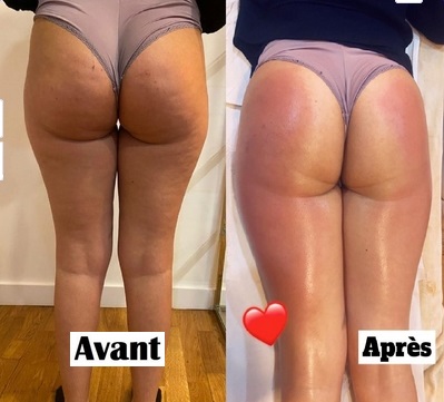 resultat avant apres cellulite cuisses velashape lpg marseille plan de cuques allauch 13013