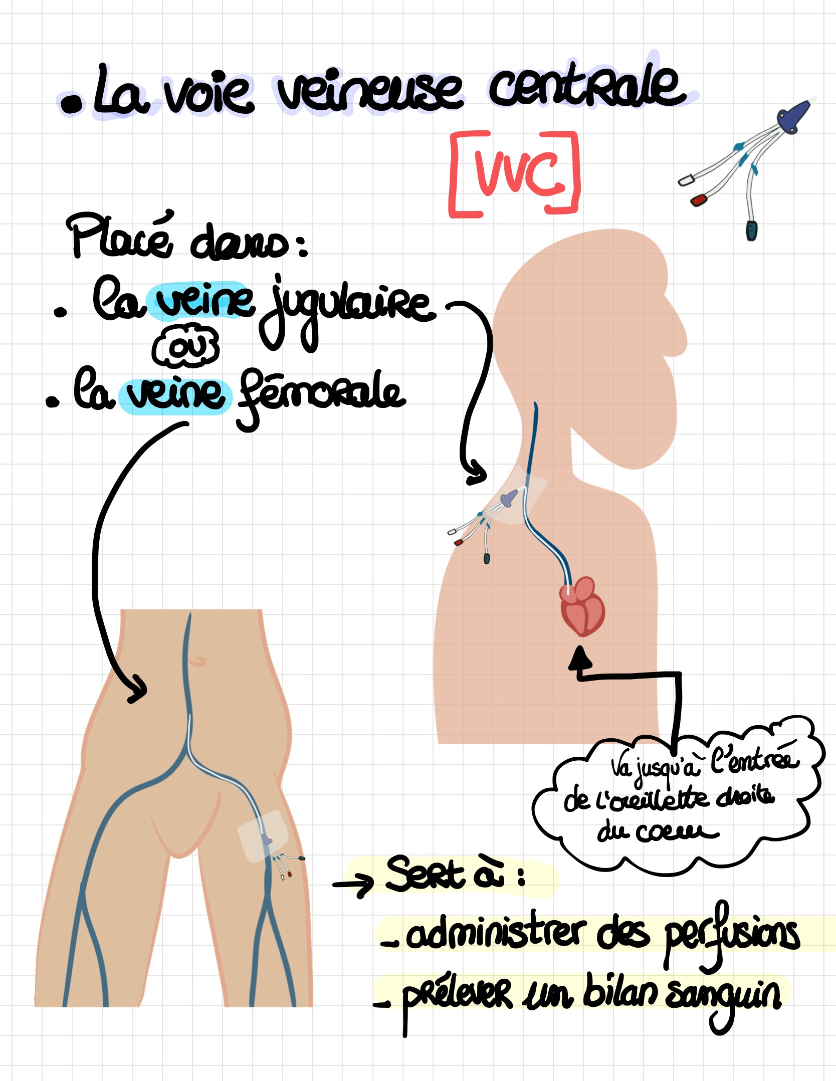 Les diffe rentes voies d abords vasculaires 3