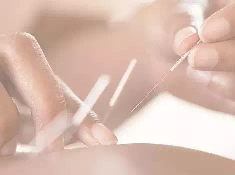 Cécile Chabot , Lyon Acupuncture, vous propose des soins d'acupuncture, stimulation des points d'acupuncture

