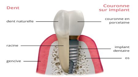 combien d’implants dentaires peut on poser en une seule fois 