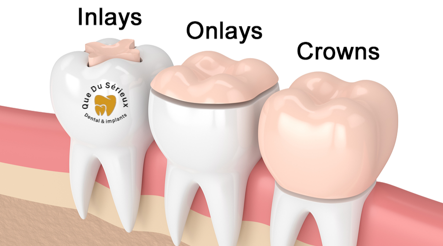 Understanding the Differences Between Inlays and Onlays