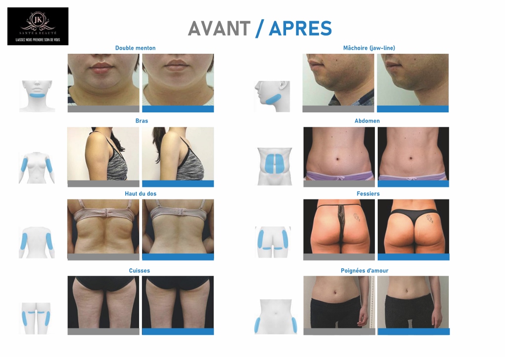 cryolipolyse pas cher aix marseille toulon allauch avant apres