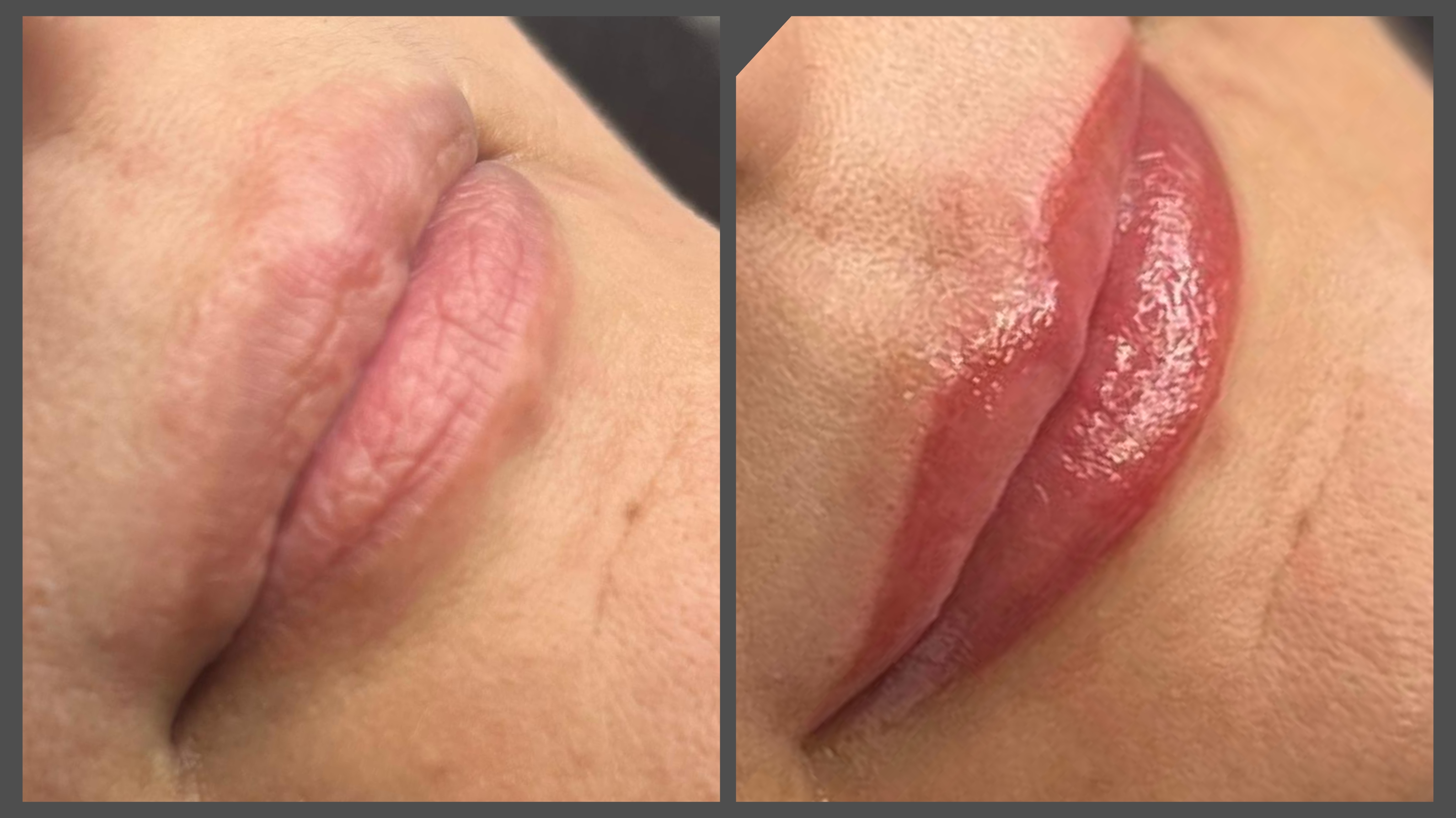 Resultat-full-lips