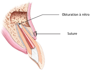 Endodontic-surgery-root-end-filling-copie