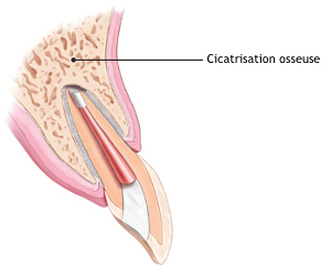 Endodontic-surgery-healed-copie
