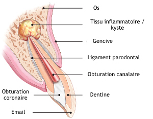 Endodontic-surgery-explained-copie
