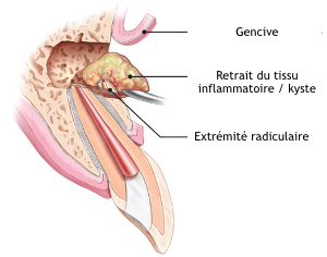 Apicoectomy-copie