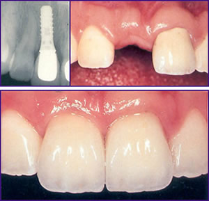 Implant2