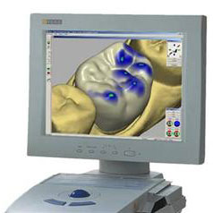 Cerec2