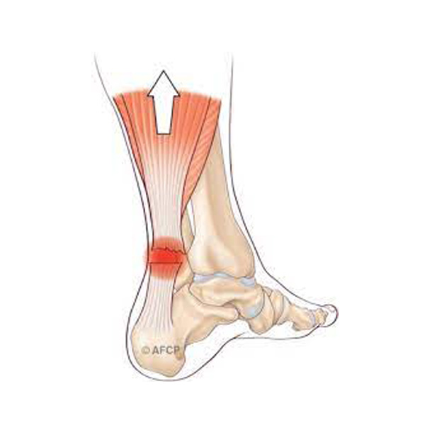 Rupture tendon achille2