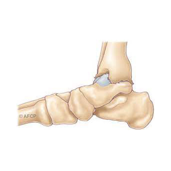 Arthrose de cheville2