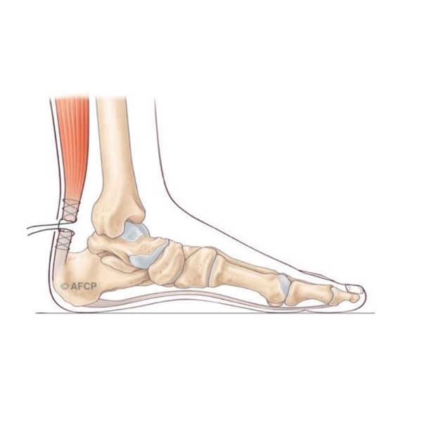 Rupture tendon achille
