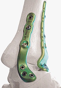 Arthrose de cheville- intervention