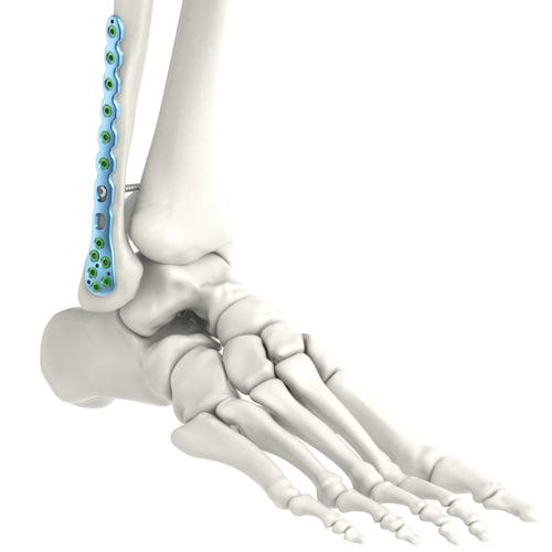 Fracture cheville intervention