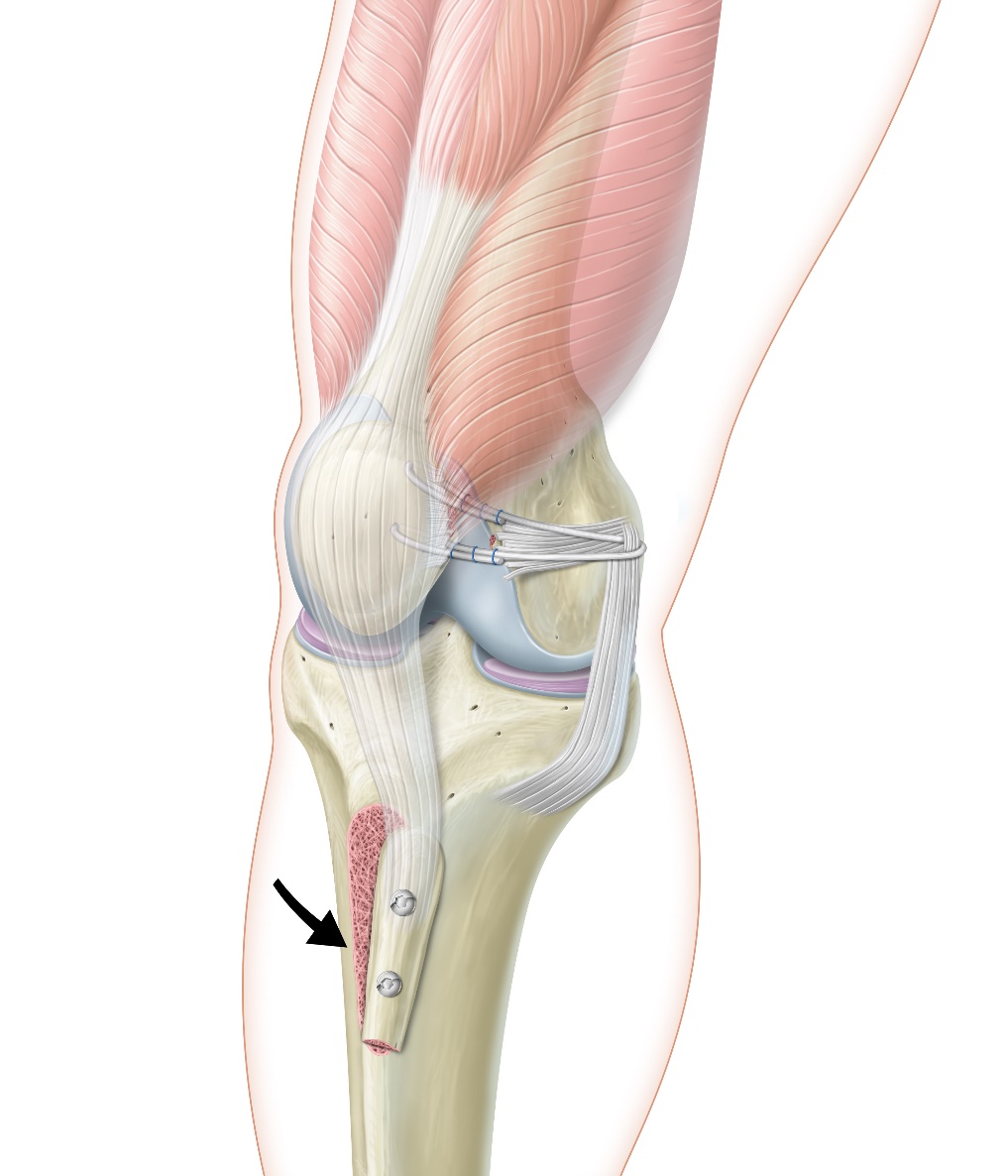 Transposition tuberosiete tibial anterieur