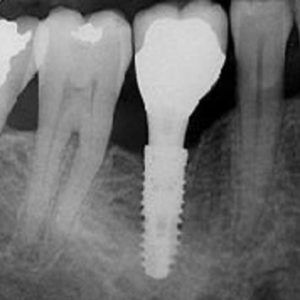 Implant 2