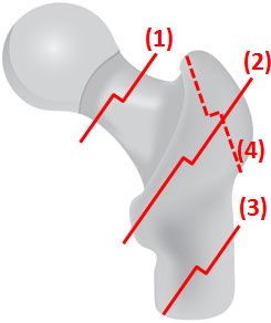 Fracture de hanche 1