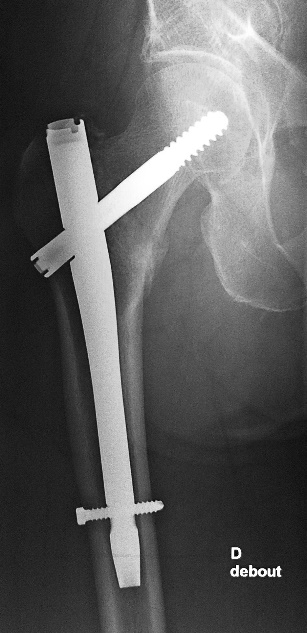 Fracture de hanche 2