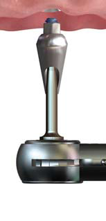 Implant9