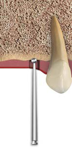 Implant1