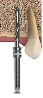 Implant2