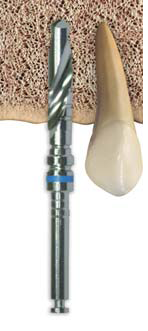 Implant3