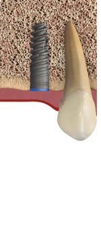 Implant5