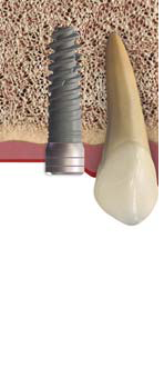 Implant6