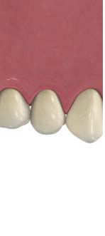 Implant8
