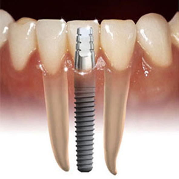 4ztgx 8 8toothimplant