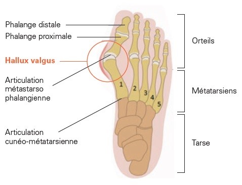 Hallux valgus 1