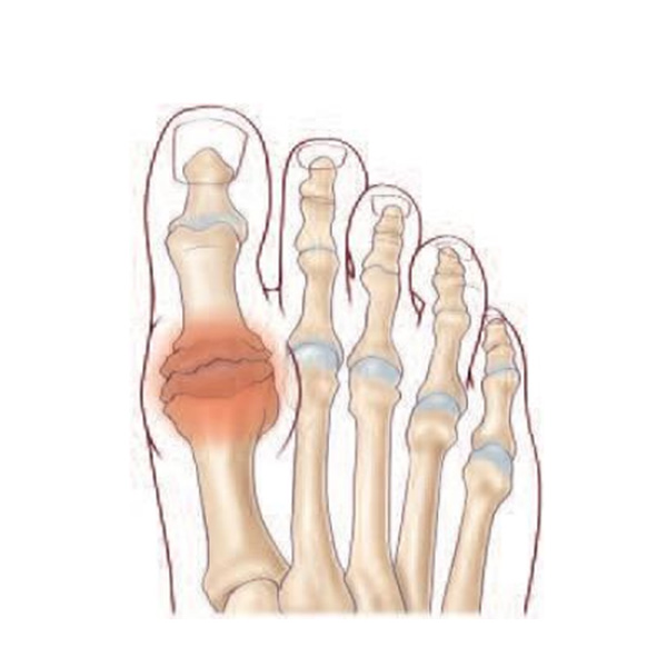 Hallux rigidus3