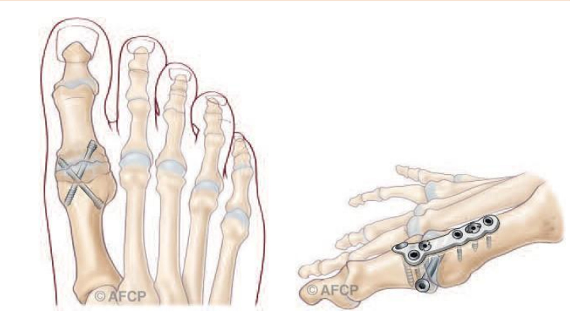 Hallux rigidus4